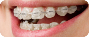 Aparelho para os dentes quase imperceptíveis